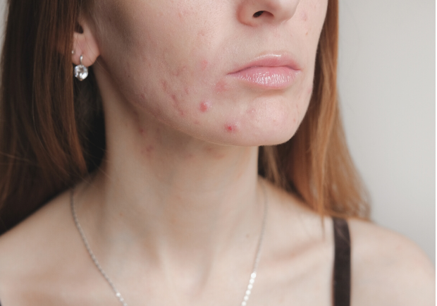 オイル洗顔、オイル美容で毛穴が悪化!?ベビーオイルやホホバオイルの間違った使い方